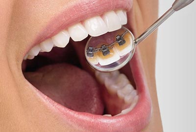 Scovolino dentale: come usarlo e quale scegliere - Studio Dentistico  Delfino Anzisi