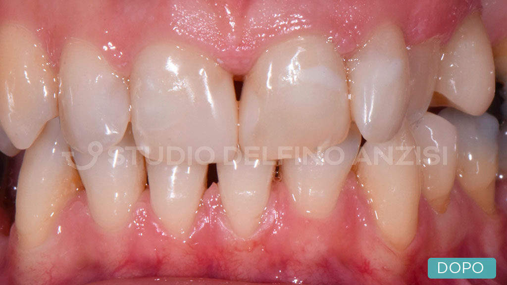 Ricostruzione denti consumati, riabilitazioni dentarie - Studio Dentistico  Bianchini Rimini